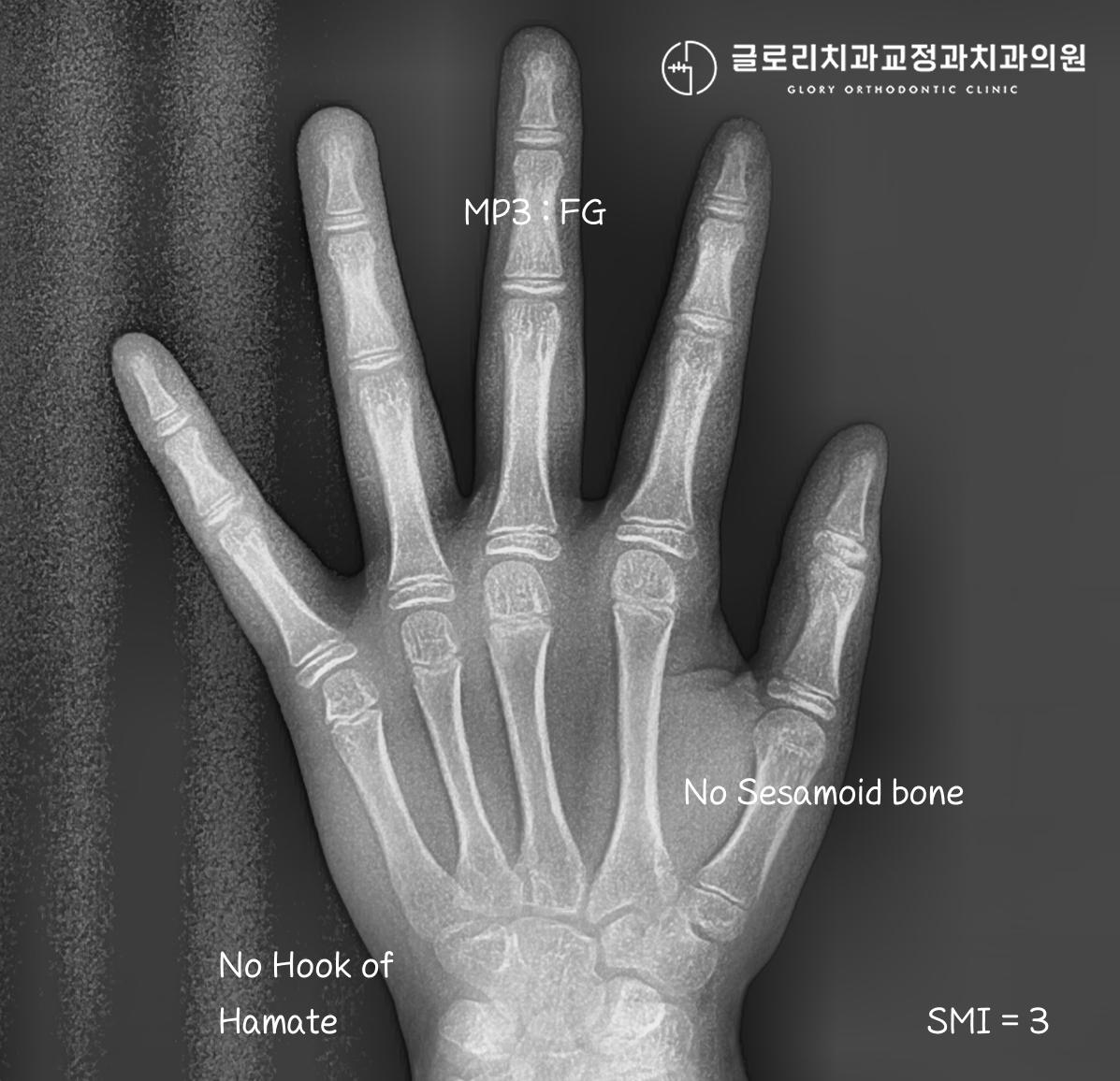 수완부 방사선사진 — SMI 성장단계 평가