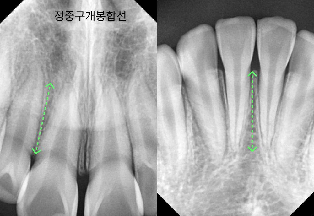 전치부 치근 길이 계측
