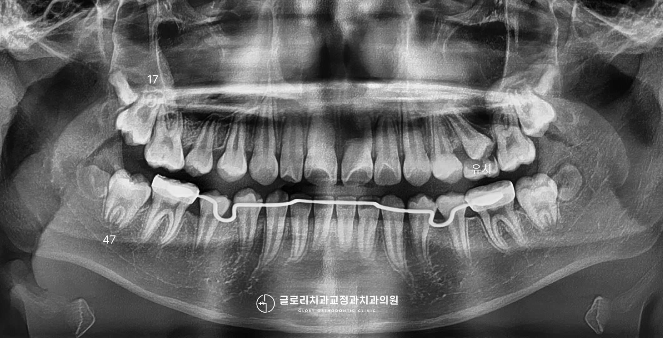 파노라마 재평가 — lingual arch 및 제2대구치 치배