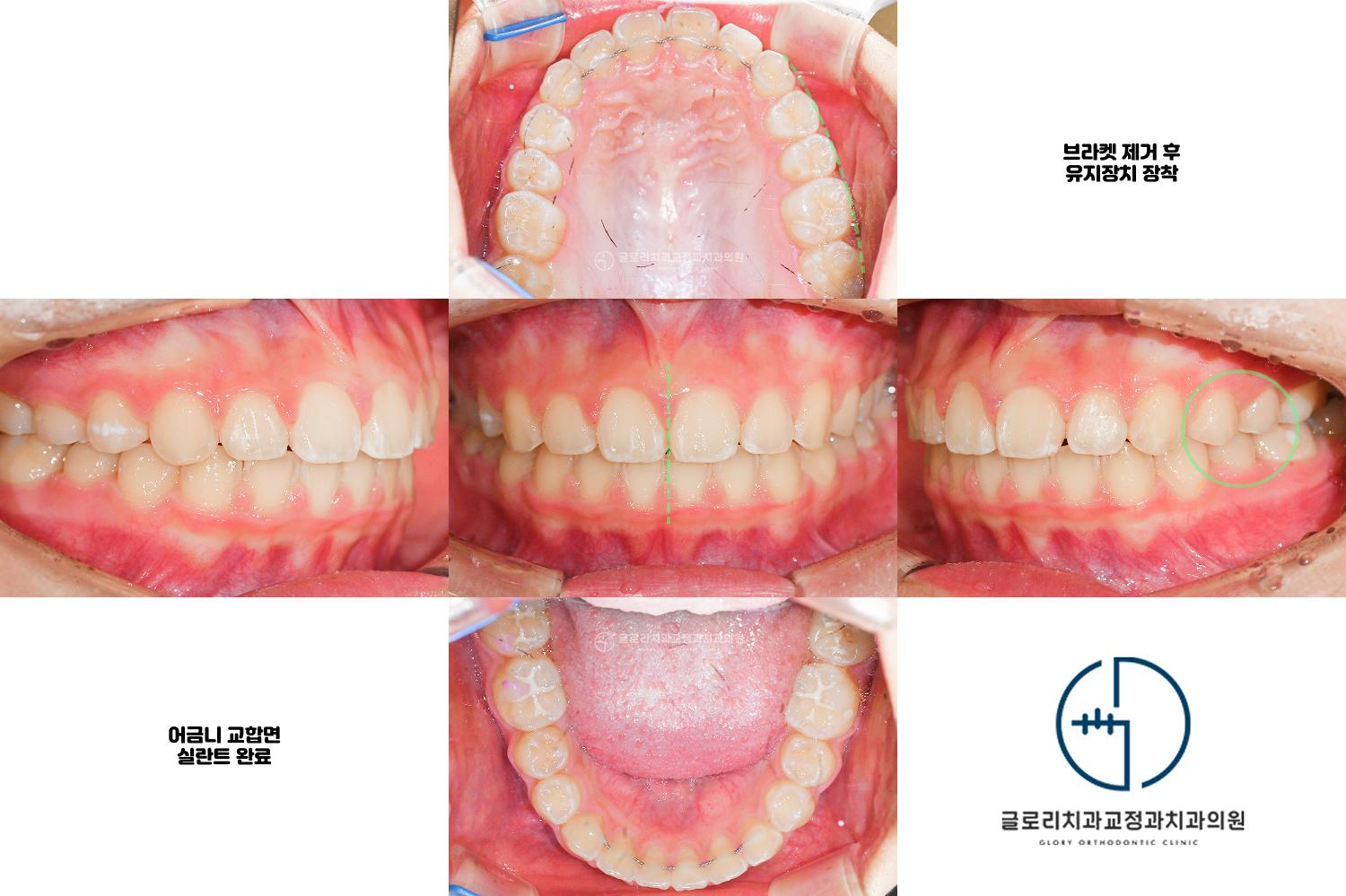 교정치료 종료 구내사진 — 브라켓 제거, 유지장치 장착, 어금니 실란트 완료