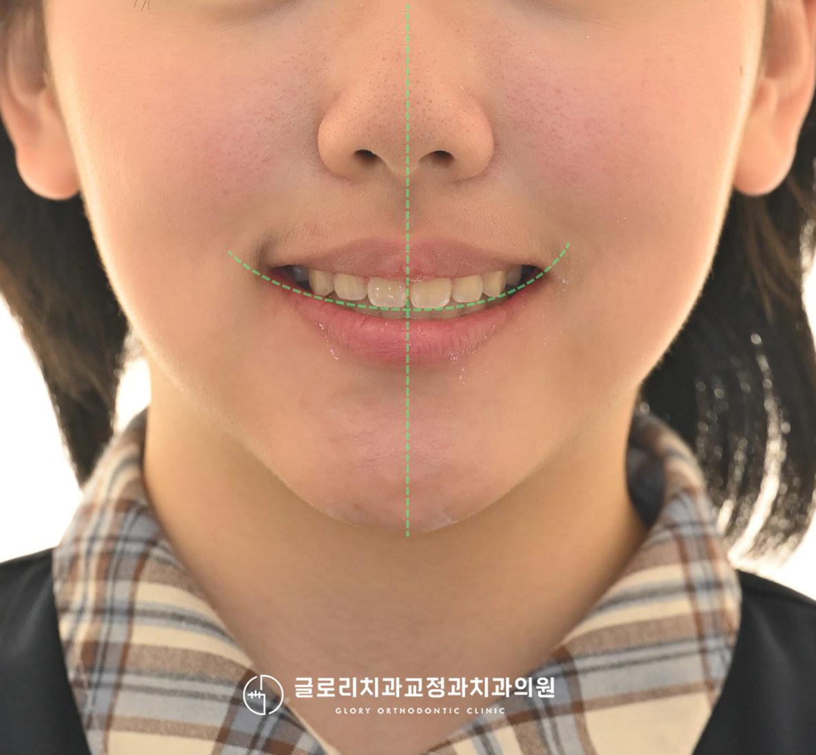 교정치료 종료 정면 안모