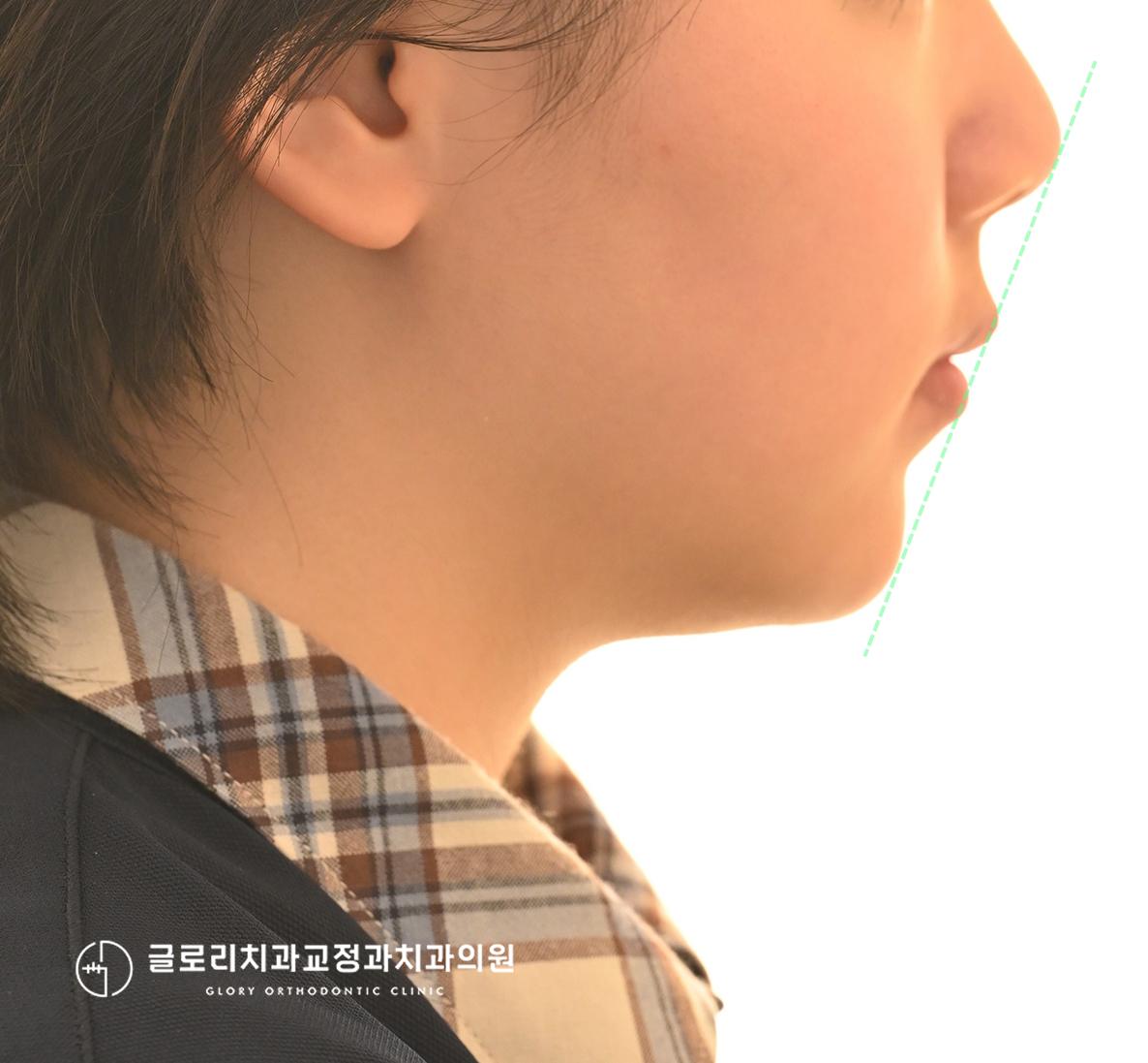 초진 측면 안모