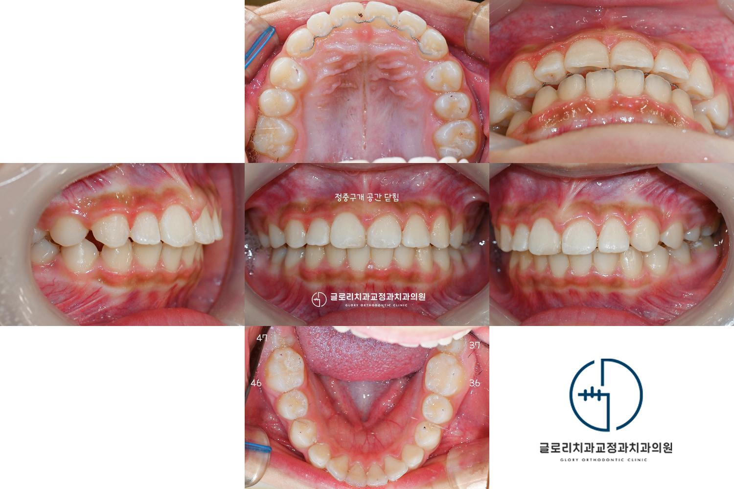 최종 구내사진 — 정중구개 공간 닫힘