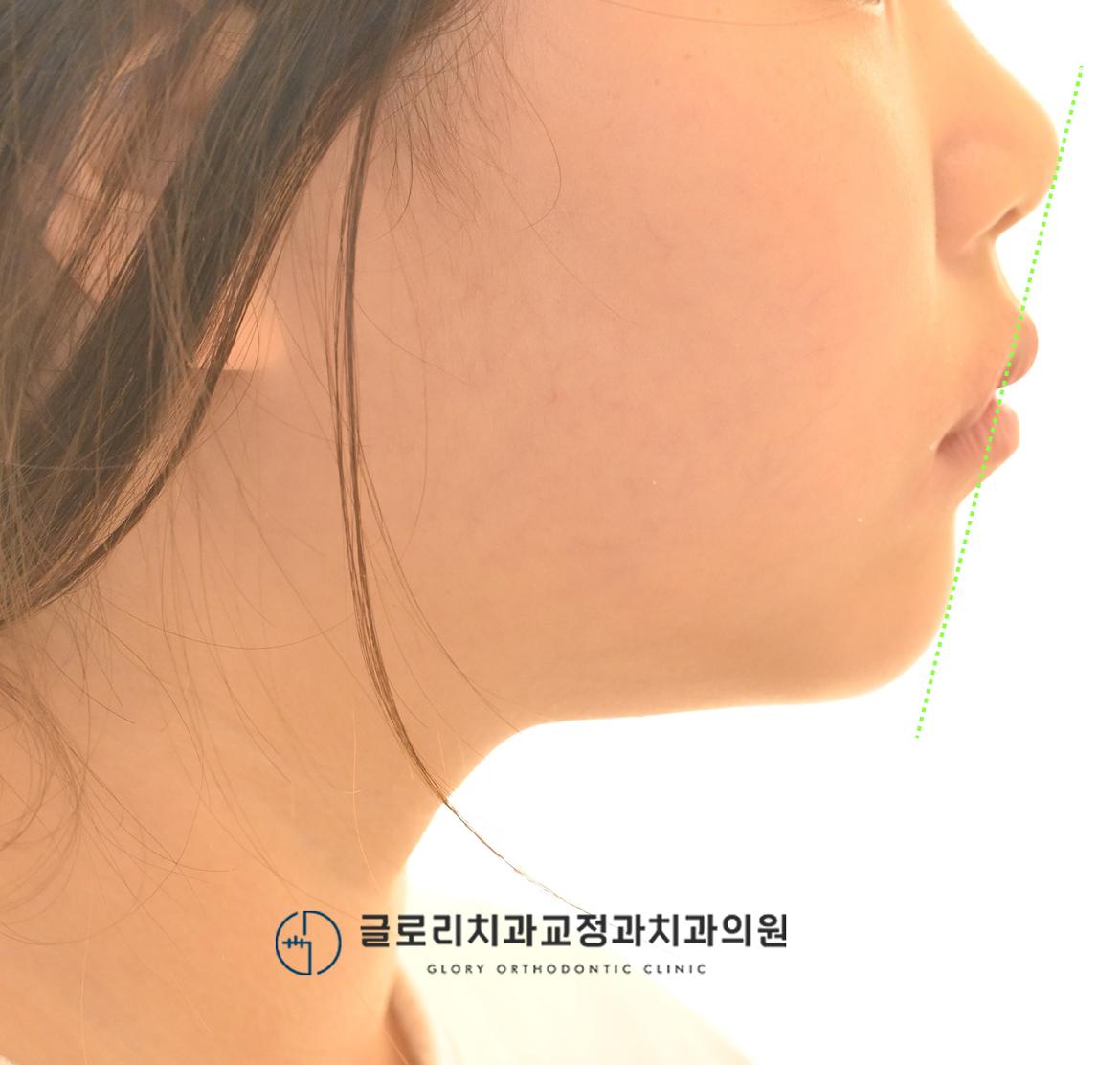 1차 교정치료 종료 측면 안모