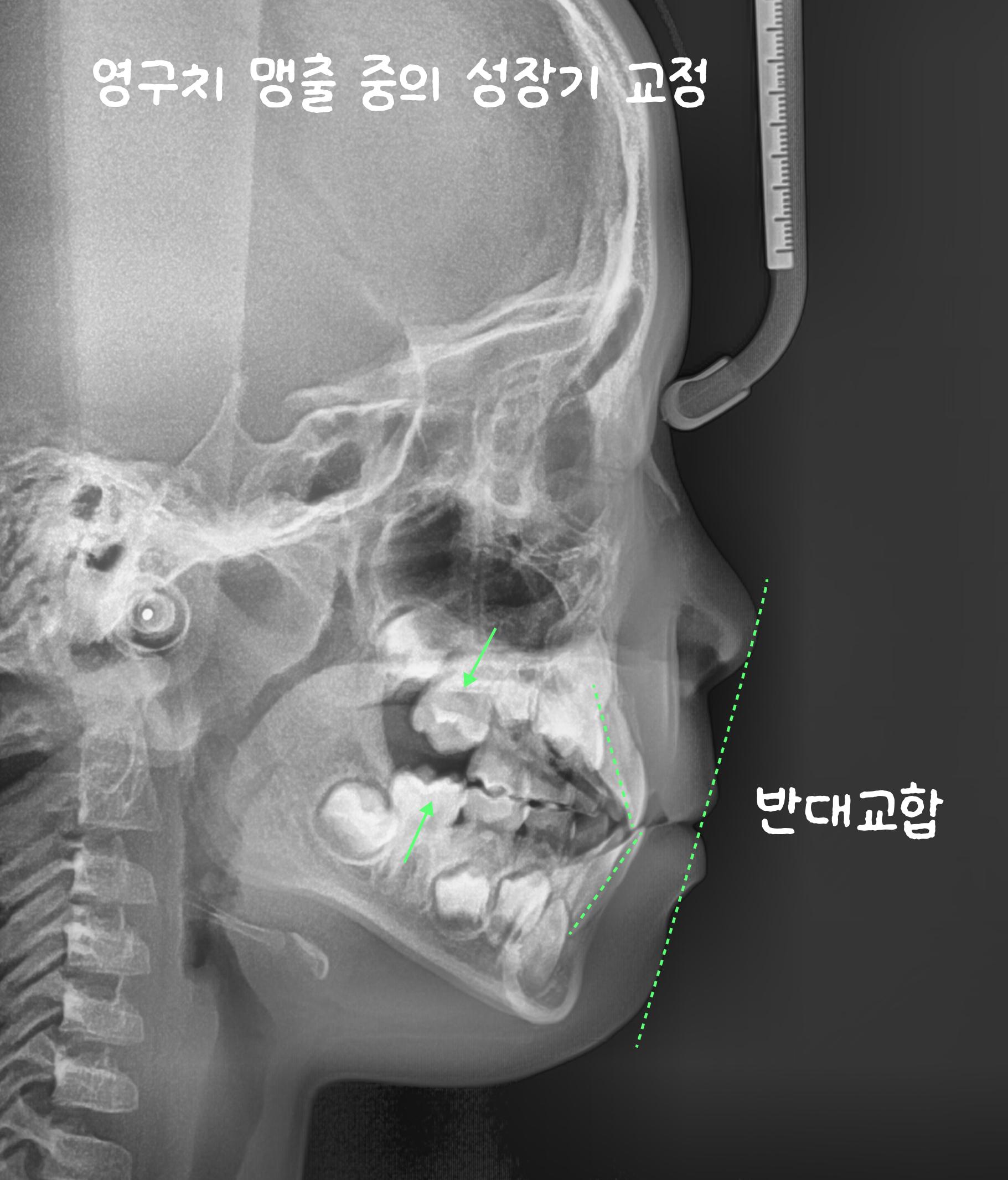 초진 측면 세팔로 — 영구치 맹출 중의 성장기 교정, 전치부 반대교합 소견
