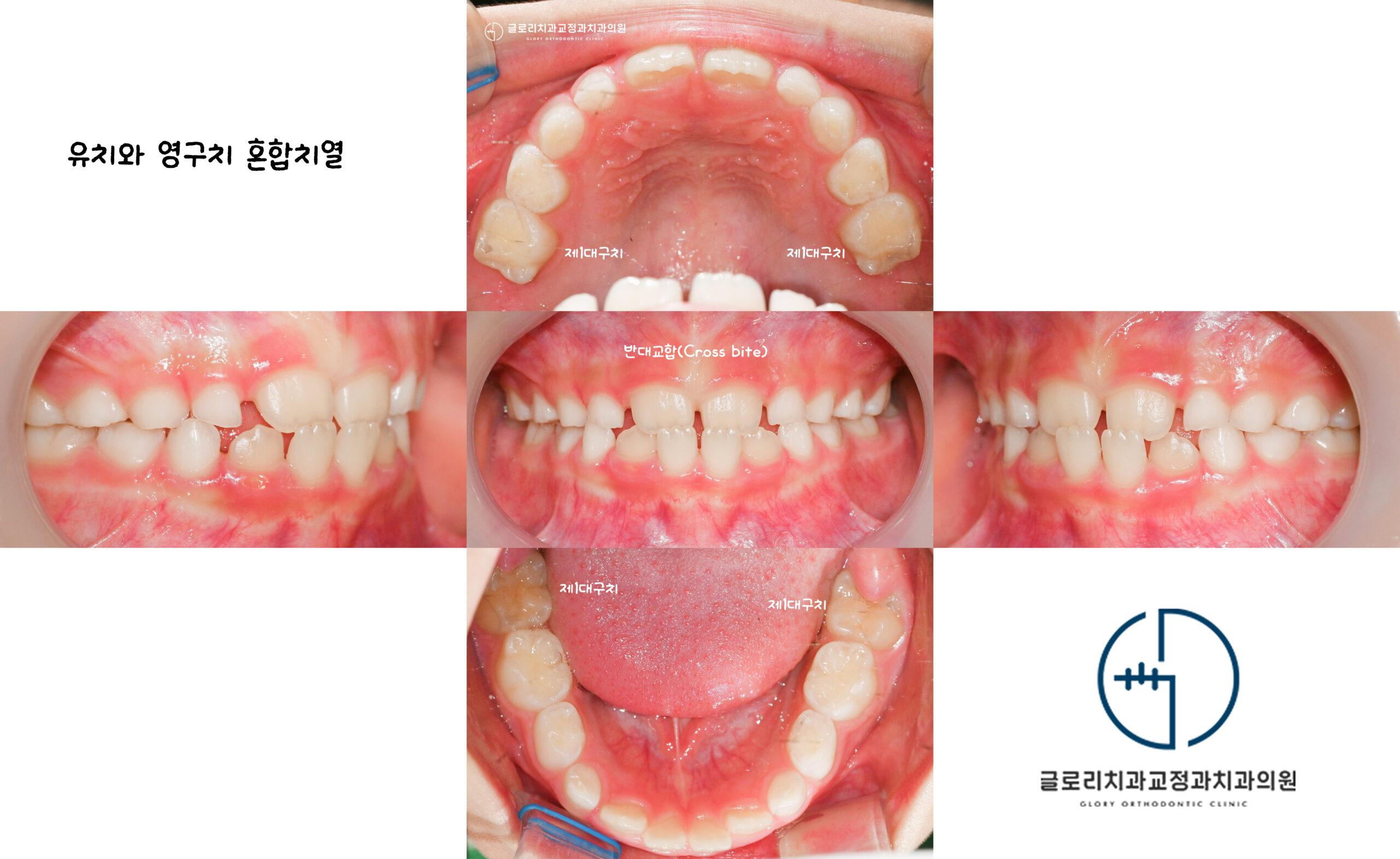 초진 구내 5컷 — 유치·영구치 혼합치열, 전치부 반대교합(Cross bite) 확인