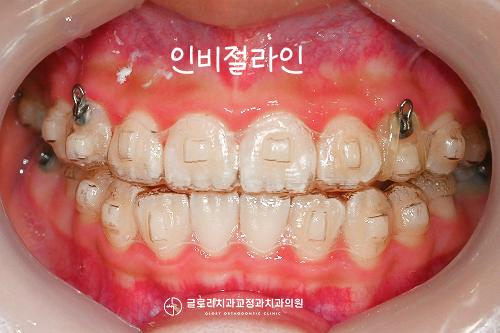 5. 위아래 치아가 긴밀하게 맞물리지 않고 삐뚤빼뚤하다면? 망우동교정치과