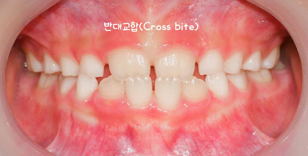 7. 양원역치과, 프리올소(Pre-Ortho)를 활용한 성장기 1차 부정교합 교정 과정 안내