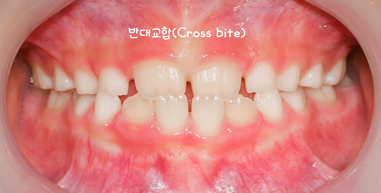 You are currently viewing 7. 양원역치과, 프리올소(Pre-Ortho)를 활용한 성장기 1차 부정교합 교정 과정 안내